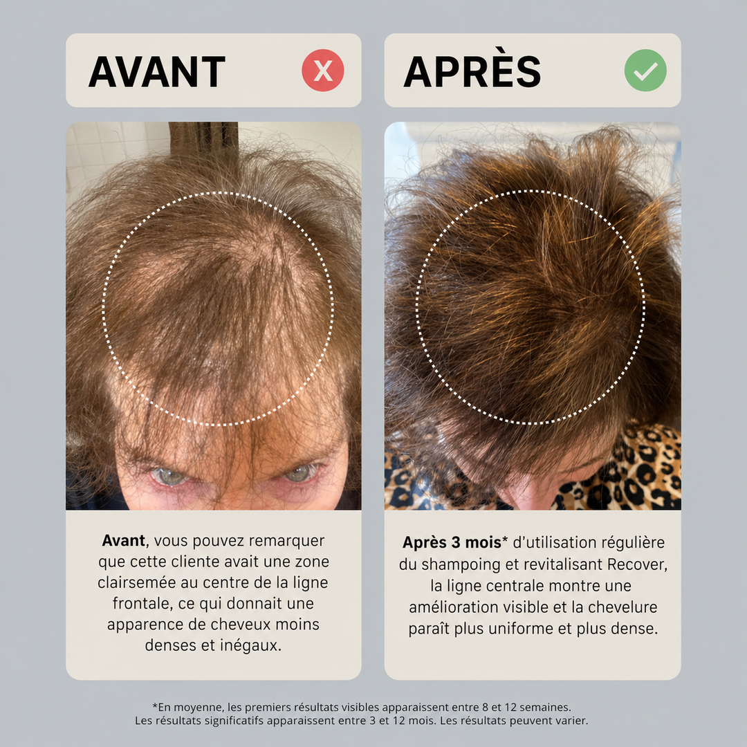 Comparaison avant après 3 mois chez une femme montrant une densité capillaire améliorée avec une ligne centrale plus uniforme et des cheveux visiblement plus épais.