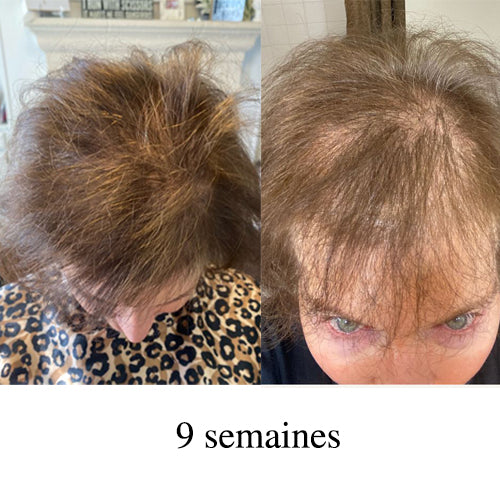 Résultats capillaires après 9 semaines chez une femme avec cheveux fins, montrant une meilleure couverture du cuir chevelu et un volume visiblement augmenté au niveau des racines.