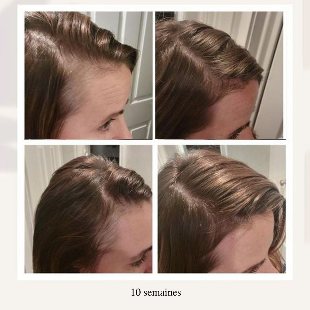 Évolution de la densité capillaire sur 10 semaines chez une femme, avec repousse visible au niveau des tempes et de la ligne frontale pour des cheveux plus épais et uniformes.