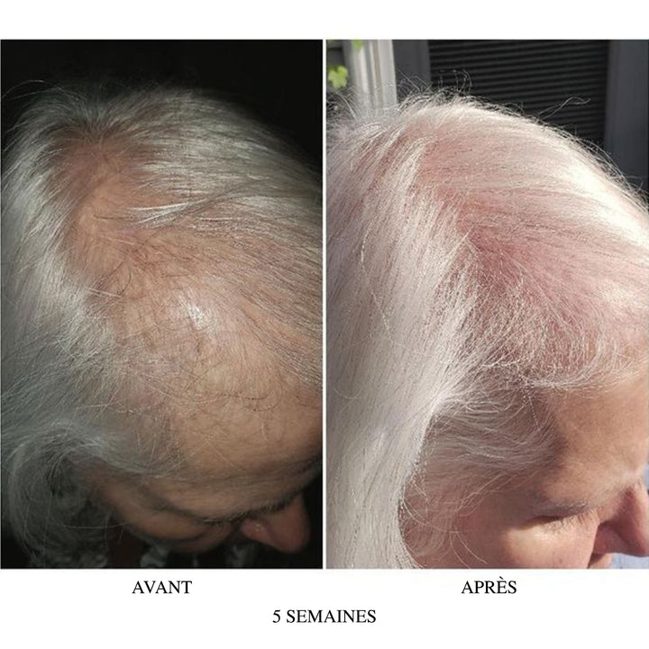 Comparaison avant après 5 semaines chez une femme aux cheveux gris montrant une amélioration de la densité capillaire et une réduction des zones clairsemées sur le cuir chevelu.