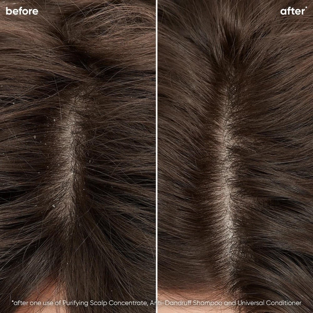 Comparaison avant/après du cuir chevelu avec pellicules visibles à gauche et cuir chevelu propre et sain à droite, après l’utilisation du shampoing antipelliculaire Biolage ScalpSync. Résultat visible dès la première utilisation, effet purifiant.
