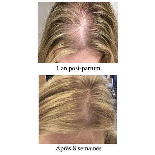 Résultats capillaires après chute de cheveux post-partum chez une femme, avec amélioration visible de la densité et réduction des zones dégarnies après 8 semaines d’utilisation.